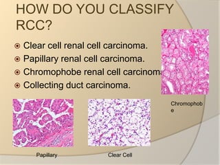 HOW DO YOU CLASSIFY RCC?Clear cell renal cell carcinoma.Papillary renal cell carcinoma.Chromophobe renal cell carcinoma.Collecting duct carcinoma.ChromophobeClear Cell Papillary 