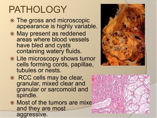 PATHOLOGYThe gross and microscopic appearance is highly variable.May present as reddened areas where blood vessels have bled and cysts containing watery fluids.Lite microscopy shows tumor cells forming cords, papillae, tubules or nests.  RCC cells may be clear, granular, mixed clear and granular or sarcomoid and spindle.Most of the tumors are mixed and they are most aggressive.