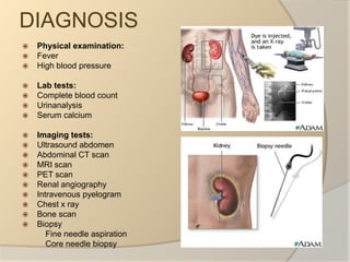 DIAGNOSISPhysical examination:FeverHigh blood pressureLab tests: Complete blood countUrinanalysisSerum calciumImaging tests:Ultrasound abdomen Abdominal CT scanMRI scanPET scanRenal angiographyIntravenous pyelogramChest x rayBone scanBiopsy          Fine needle aspiration          Core needle biopsy