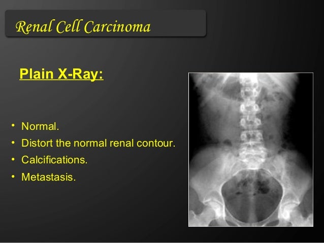 Renal Rcc Radiopaedia Renal Cell Carcinoma Xray