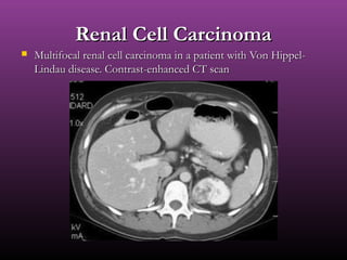Renal Cell CarcinomaRenal Cell Carcinoma
 Multifocal renal cell carcinoma in a patient with Von Hippel-Multifocal renal cell carcinoma in a patient with Von Hippel-
Lindau disease. Contrast-enhanced CT scanLindau disease. Contrast-enhanced CT scan
 
