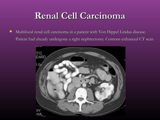 Renal Cell CarcinomaRenal Cell Carcinoma
 Multifocal renal cell carcinoma in a patient with Von Hippel Lindau disease.Multifocal renal cell carcinoma in a patient with Von Hippel Lindau disease.
Patient had already undergone a right nephrectomy. Contrast-enhanced CT scanPatient had already undergone a right nephrectomy. Contrast-enhanced CT scan
 