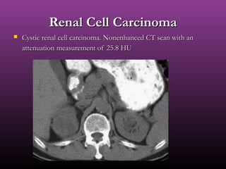 Renal Cell CarcinomaRenal Cell Carcinoma
 Cystic renal cell carcinoma. Nonenhanced CT scan with anCystic renal cell carcinoma. Nonenhanced CT scan with an
attenuation measurement of 25.8 HUattenuation measurement of 25.8 HU
 