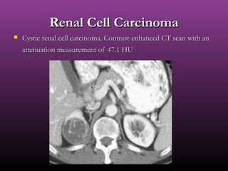 Renal Cell CarcinomaRenal Cell Carcinoma
 Cystic renal cell carcinoma. Contrast-enhanced CT scan with anCystic renal cell carcinoma. Contrast-enhanced CT scan with an
attenuation measurement of 47.1 HUattenuation measurement of 47.1 HU
 