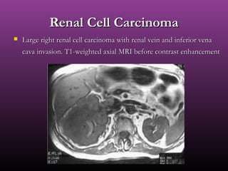 Renal Cell CarcinomaRenal Cell Carcinoma
 Large right renal cell carcinoma with renal vein and inferior venaLarge right renal cell carcinoma with renal vein and inferior vena
cava invasion. T1-weighted axial MRI before contrast enhancementcava invasion. T1-weighted axial MRI before contrast enhancement
 