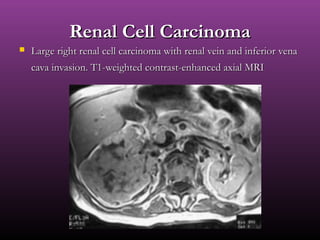 Renal Cell CarcinomaRenal Cell Carcinoma
 Large right renal cell carcinoma with renal vein and inferior venaLarge right renal cell carcinoma with renal vein and inferior vena
cava invasion. T1-weighted contrast-enhanced axial MRIcava invasion. T1-weighted contrast-enhanced axial MRI
 