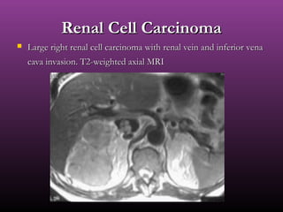 Renal Cell CarcinomaRenal Cell Carcinoma
 Large right renal cell carcinoma with renal vein and inferior venaLarge right renal cell carcinoma with renal vein and inferior vena
cava invasion. T2-weighted axial MRIcava invasion. T2-weighted axial MRI
 