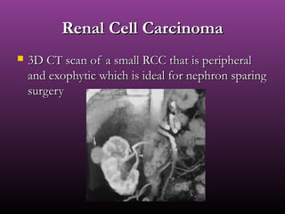 Renal Cell CarcinomaRenal Cell Carcinoma
 3D CT scan of a small RCC that is peripheral3D CT scan of a small RCC that is peripheral
and exophytic which is ideal for nephron sparingand exophytic which is ideal for nephron sparing
surgerysurgery
 