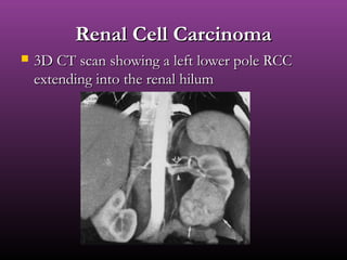 Renal Cell CarcinomaRenal Cell Carcinoma
 3D CT scan showing a left lower pole RCC3D CT scan showing a left lower pole RCC
extending into the renal hilumextending into the renal hilum
 