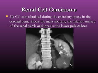 Renal Cell CarcinomaRenal Cell Carcinoma
 3D CT scan obtained during the excretory phase in the3D CT scan obtained during the excretory phase in the
coronal plane shows the mass abutting the inferior surfacecoronal plane shows the mass abutting the inferior surface
of the renal pelvis and invades the lower pole calicesof the renal pelvis and invades the lower pole calices
 