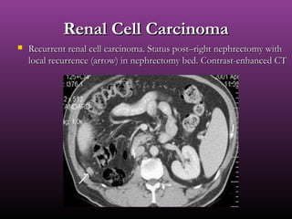 Renal Cell CarcinomaRenal Cell Carcinoma
 Recurrent renal cell carcinoma. Status post–right nephrectomy withRecurrent renal cell carcinoma. Status post–right nephrectomy with
local recurrence (arrow) in nephrectomy bed. Contrast-enhanced CTlocal recurrence (arrow) in nephrectomy bed. Contrast-enhanced CT
 