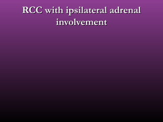 RCC with ipsilateral adrenalRCC with ipsilateral adrenal
involvementinvolvement
 