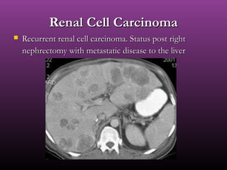 Renal Cell CarcinomaRenal Cell Carcinoma
 Recurrent renal cell carcinoma. Status post rightRecurrent renal cell carcinoma. Status post right
nephrectomy with metastatic disease to the livernephrectomy with metastatic disease to the liver
 