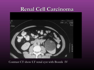 Renal Cell CarcinomaRenal Cell Carcinoma
Contrast CT show LT renal cyst with Bosnik IV
 