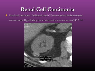 Renal Cell CarcinomaRenal Cell Carcinoma
 Renal cell carcinoma. Dedicated renal CT scan obtained before contrastRenal cell carcinoma. Dedicated renal CT scan obtained before contrast
enhancement. Right kidney has an attenuation measurement of 45.7 HUenhancement. Right kidney has an attenuation measurement of 45.7 HU
 
