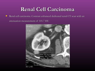 Renal Cell CarcinomaRenal Cell Carcinoma
 Renal cell carcinoma. Contrast-enhanced dedicated renal CT scan with anRenal cell carcinoma. Contrast-enhanced dedicated renal CT scan with an
attenuation measurement of 101.7 HUattenuation measurement of 101.7 HU
 