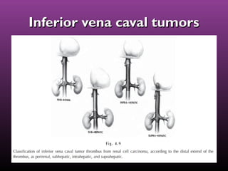 Inferior vena caval tumorsInferior vena caval tumors
 