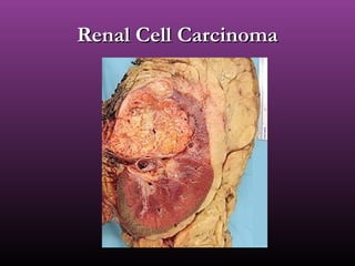 Renal Cell CarcinomaRenal Cell Carcinoma
 