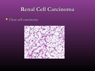Renal Cell CarcinomaRenal Cell Carcinoma
 Clear cell carcinomaClear cell carcinoma
 