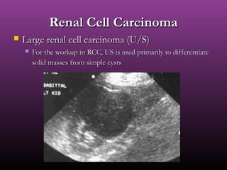 Renal Cell CarcinomaRenal Cell Carcinoma
 Large renal cell carcinoma (U/S)Large renal cell carcinoma (U/S)
 For the workup in RCC, US is used primarily to differentiateFor the workup in RCC, US is used primarily to differentiate
solid masses from simple cystssolid masses from simple cysts
 
