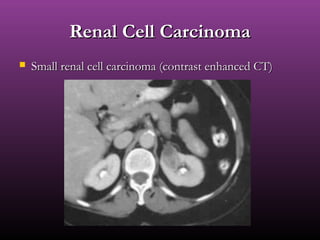 Renal Cell CarcinomaRenal Cell Carcinoma
 Small renal cell carcinoma (contrast enhanced CT)Small renal cell carcinoma (contrast enhanced CT)
 