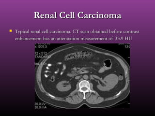 Renal Cell CarcinomaRenal Cell Carcinoma
 Typical renal cell carcinoma. CT scan obtained before contrastTypical renal cell carcinoma. CT scan obtained before contrast
enhancement has an attenuation measurement of 33.9 HUenhancement has an attenuation measurement of 33.9 HU
 