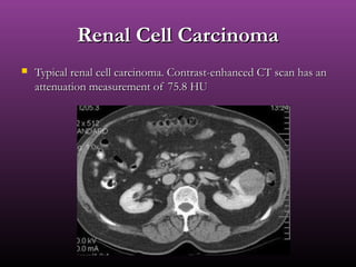Renal Cell CarcinomaRenal Cell Carcinoma
 Typical renal cell carcinoma. Contrast-enhanced CT scan has anTypical renal cell carcinoma. Contrast-enhanced CT scan has an
attenuation measurement of 75.8 HUattenuation measurement of 75.8 HU
 