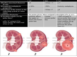 RCC- Staging and treatment of Renal Cell Carcinoma | PPTX