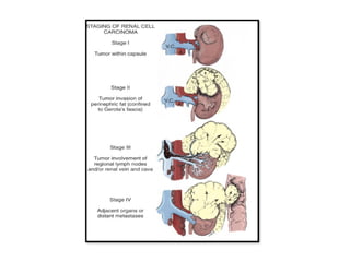 RCC renal cell carcinoma and it's managemnet | PPTX