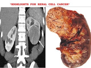 *HIGHLIGHTS FOR RENAL CELL CANCER*
 