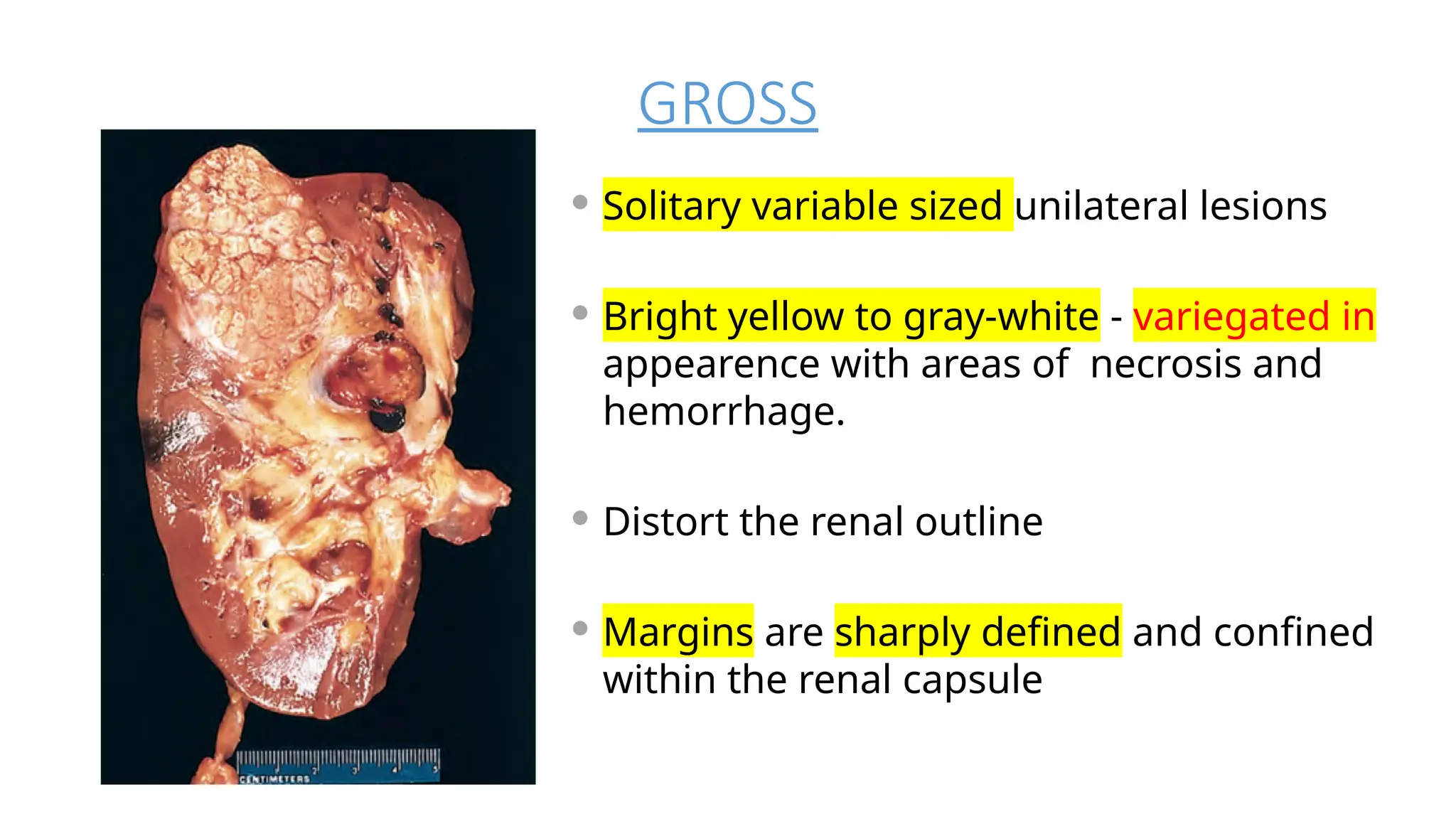 RCC PDF pathology 2nd year kidney renal ves | PPTX