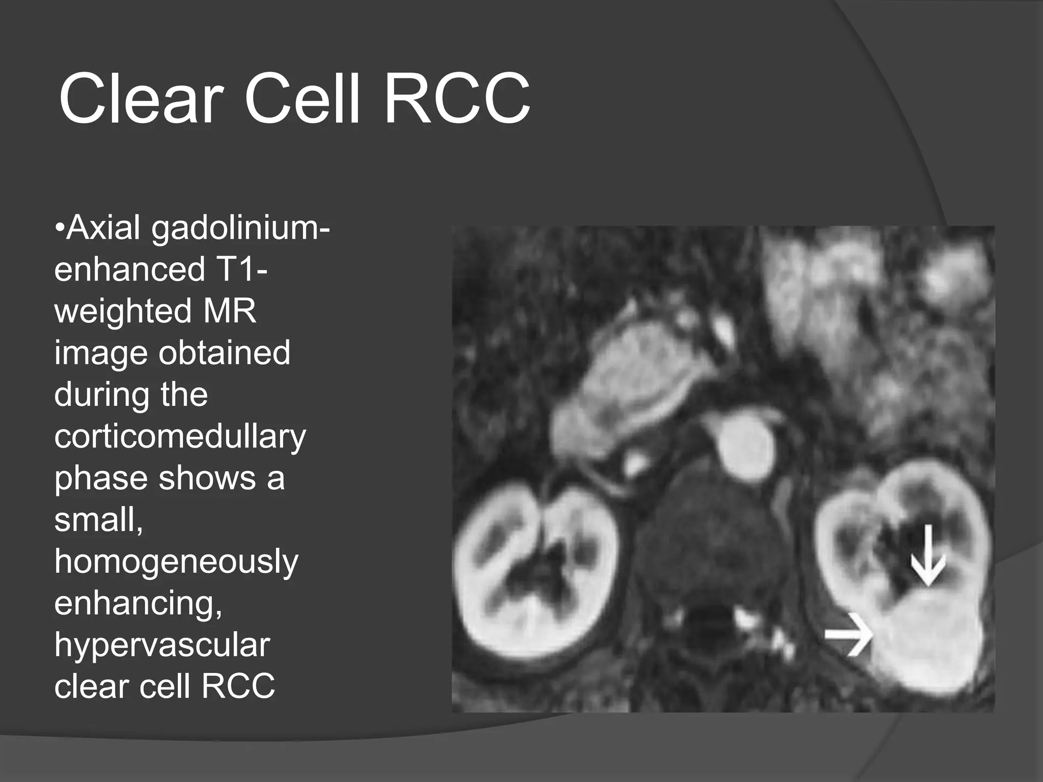 renal cell carcinoma radiology | PPTX