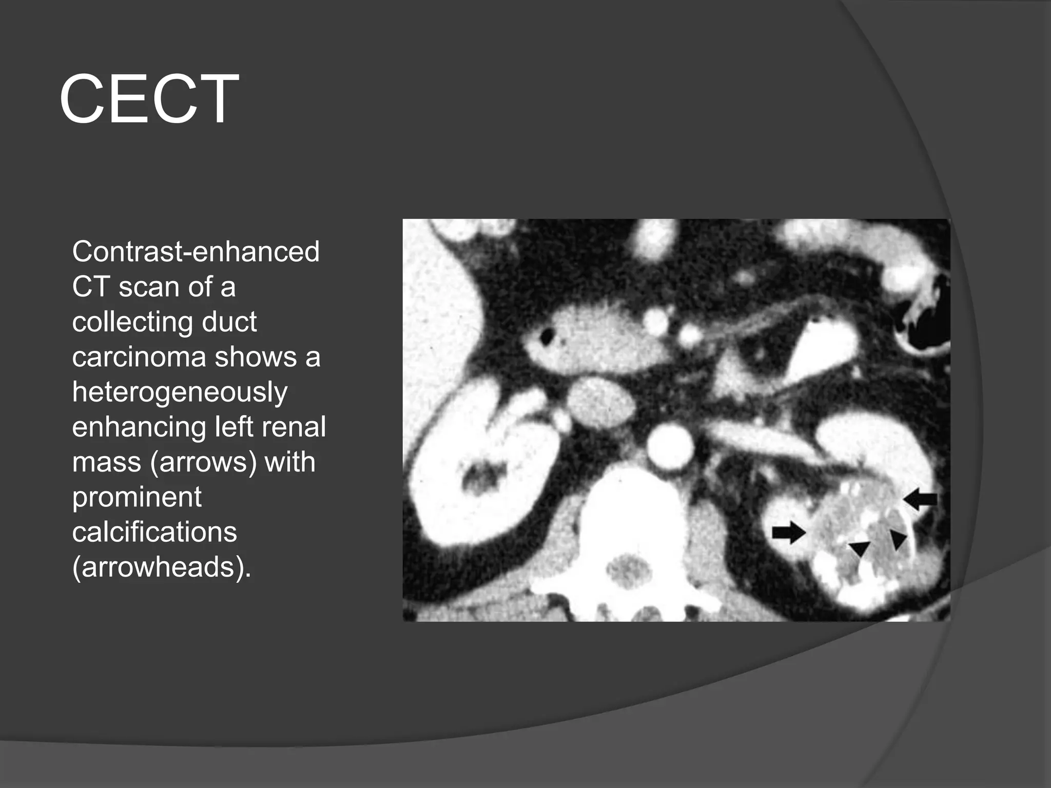 renal cell carcinoma radiology | PPTX