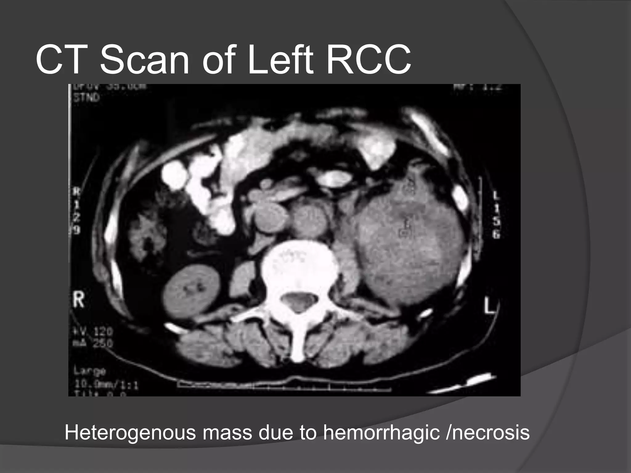 renal cell carcinoma radiology | PPTX