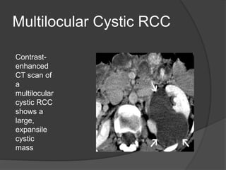 renal cell carcinoma radiology | PPTX
