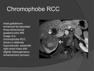 renal cell carcinoma radiology | PPTX