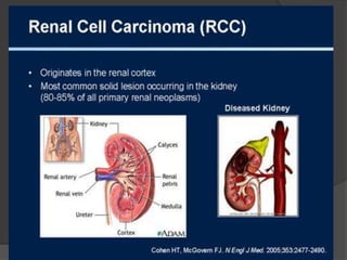 renal cell carcinoma radiology | PPTX