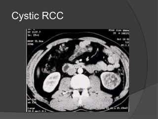 renal cell carcinoma radiology | PPTX