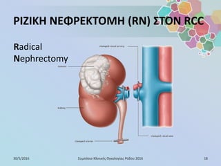 ΡΙΖΙΚΗ ΝΕΦΡΕΚΤΟΜΗ (RN) ΣΤΟΝ RCC
30/5/2016 18Συμπόσιο Κλινικής Ογκολογίας Ρόδου 2016
Radical
Nephrectomy
 