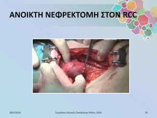 ΑΝΟΙΚΤΗ ΝΕΦΡΕΚΤΟΜΗ ΣΤΟΝ RCC
30/5/2016 20Συμπόσιο Κλινικής Ογκολογίας Ρόδου 2016
 