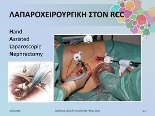 ΛΑΠΑΡΟΧΕΙΡΟΥΡΓΙΚΗ ΣΤΟΝ RCC
Hand
Assisted
Laparoscopic
Nephrectomy
30/5/2016 22Συμπόσιο Κλινικής Ογκολογίας Ρόδου 2016
 