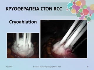 ΚΡΥΟΘΕΡΑΠΕΙΑ ΣΤΟΝ RCC
Cryoablation
30/5/2016 29Συμπόσιο Κλινικής Ογκολογίας Ρόδου 2016
 