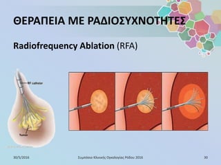 ΘΕΡΑΠΕΙΑ ΜΕ ΡΑΔΙΟΣΥΧΝΟΤΗΤΕΣ
Radiofrequency Ablation (RFA)
30/5/2016 30Συμπόσιο Κλινικής Ογκολογίας Ρόδου 2016
 