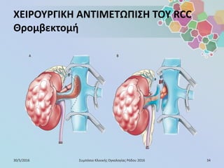 ΧΕΙΡΟΥΡΓΙΚΗ ΑΝΤΙΜΕΤΩΠΙΣΗ ΤΟΥ RCC
Θρομβεκτομή
30/5/2016 34Συμπόσιο Κλινικής Ογκολογίας Ρόδου 2016
 