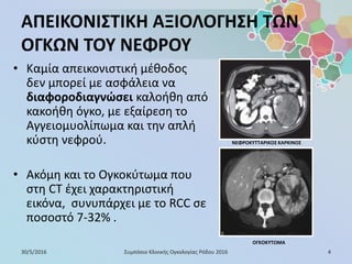 ΑΠΕΙΚΟΝΙΣΤΙΚΗ ΑΞΙΟΛΟΓΗΣΗ ΤΩΝ
ΟΓΚΩΝ ΤΟΥ ΝΕΦΡΟΥ
• Καμία απεικονιστική μέθοδος
δεν μπορεί με ασφάλεια να
διαφοροδιαγνώσει καλοήθη από
κακοήθη όγκο, με εξαίρεση το
Αγγειομυολίπωμα και την απλή
κύστη νεφρού.
• Ακόμη και το Ογκοκύτωμα που
στη CT έχει χαρακτηριστική
εικόνα, συνυπάρχει με το RCC σε
ποσοστό 7-32% .
ΝΕΦΡΟΚΥΤΤΑΡΙΚΟΣ ΚΑΡΚΙΝΟΣ
ΟΓΚΟΚΥΤΩΜΑ
30/5/2016 4Συμπόσιο Κλινικής Ογκολογίας Ρόδου 2016
 