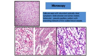 Acinar Pattern Rcc RCC update 1.pptxjkgiugiugtiugtiugtiugiugiug | PPTX