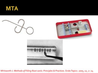 Whitworth J. Methods of Filling Root canls: Principles & Practices. EndoTopics. 2005, 12, 2- 24
 