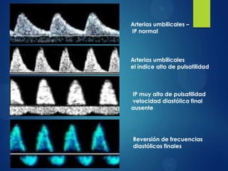 Arterias umbilicales –
IP normal
Arterias umbilicales
el índice alto de pulsatilidad
IP muy alto de pulsatilidad
velocidad diastólica final
ausente
Reversión de frecuencias
diastólicas finales
 