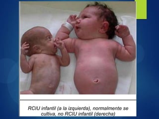 RCIU infantil (a la izquierda), normalmente se
cultiva, no RCIU infantil (derecha)
 