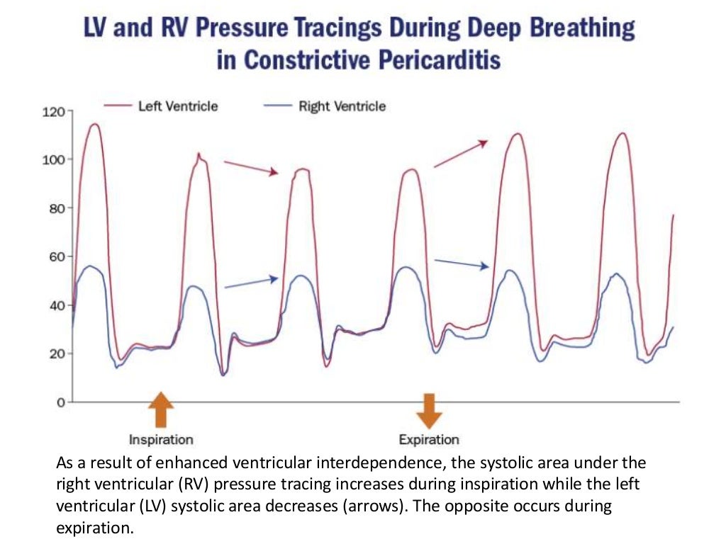 Echo Differentiation of Restrictive Cardiomyopathy and Constrictive P…